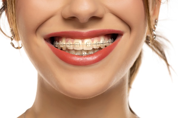 Why A Dentist May Recommend Braces For Teeth Straightening