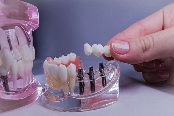 How A Dental Bridge Restores Your Smile And Improves Everyday Function