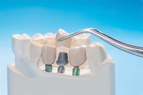 How To Take Care Of A Dental Crown