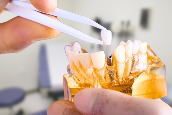 A Dental Implant Is A Permanent Tooth Replacement