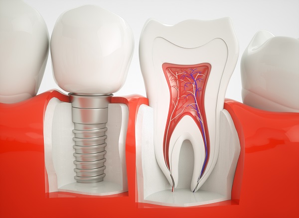 dental implant Miami, FL